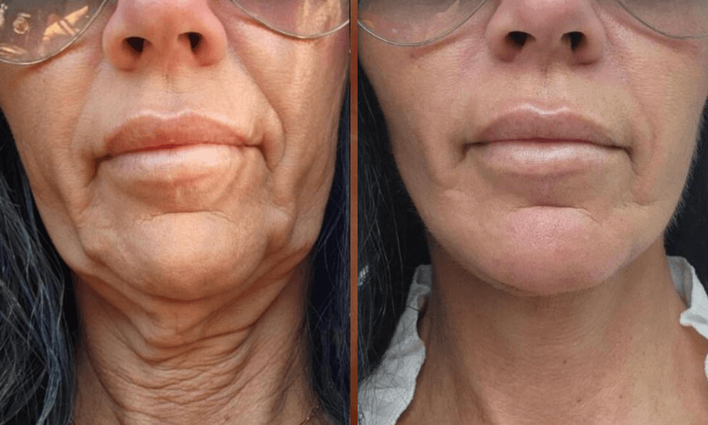 Técnica de harmonização facial feita em casa promete rejuvenescer a pele em poucos dias, segundo especialista